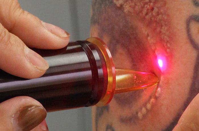 Kdy řešit korekci tetování?